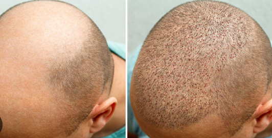 Overview of Hair Transplant Procedures