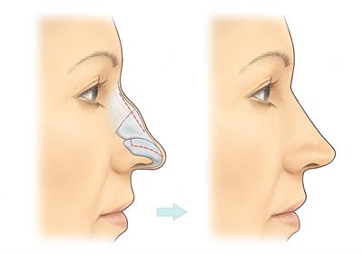 Septoplasty Recovery: 9 Tips to Follow